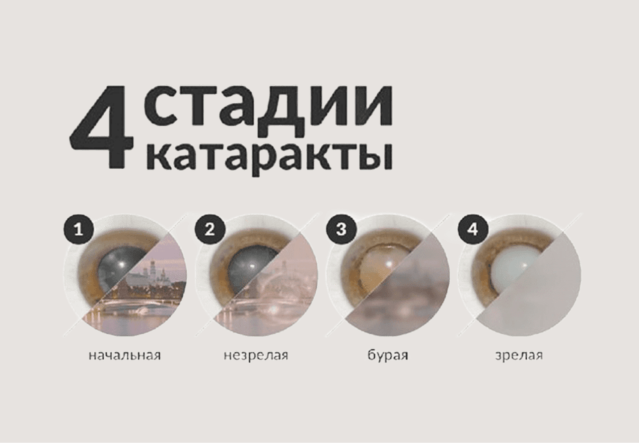 Всё о катаракте глаза: симптомы, диагностика, лечение