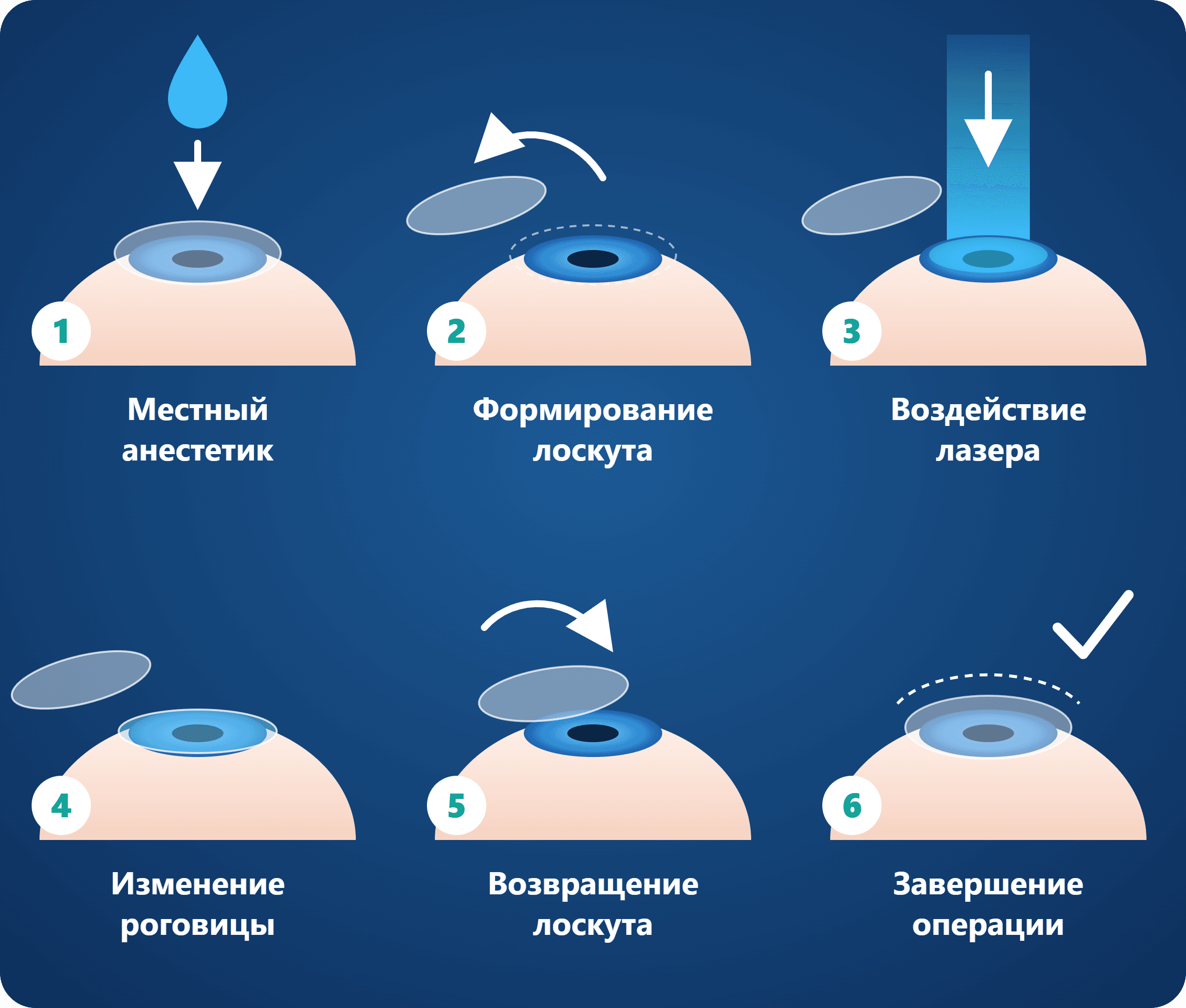Схема лазерной коррекции зрения по методике LASIK